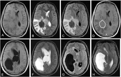 Clinical Features, Radiological Characteristics, and Outcomes of Patients With Intracranial Alveolar Echinococcosis: A Case Series From Tibetan Areas of Sichuan Province, China